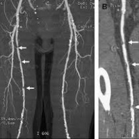 Resonancia nuclear magnetica con angiografia de extremidad inferior. 883909. Idime|