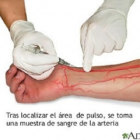 Gases arteriales en reposo y en ejercicio, cups 903839, Idime (2022)