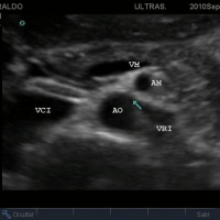Ecografia doppler de arterias iliacas a color. 882262 Idime