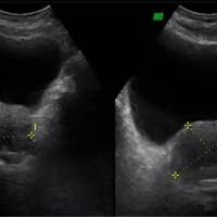 Ecografia de prostata transabdominal. 881501  Idime