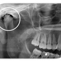 Radiografia de articulacion temporomandibular (ATM). 870131 Idime