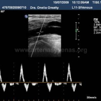 Ecografia doppler con evaluacion de flujo sanguineo en masas abdominales a color. 882292  Idime