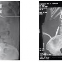 Pielografia a traves de tubos de nefrostomia.877812 Idime