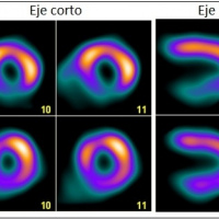 Perfusion miocardica con estres farmacologico.920408  Idime (2024)