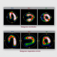 Gamagrafia de miocardio con pirofosfatos.920410  Idime (2024)