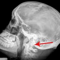 Radiografia de conducto auditivo interno. 870007 Idime