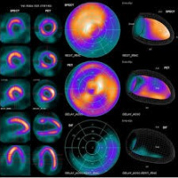 Gamagrafia de viabilidad miocardica con Talio o marcadores TC. 920414 Idime (2024)