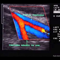 Duplex de vasos arteriales de miembro superior a color (UNO). 882307 Idime