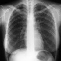 Radiografia de torax (PA y lateral) 871121 Idime