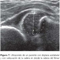 Ecografia articular de cadera. 881630  Idime