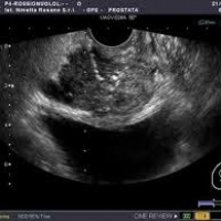 Ecografia de prostata transrectal. Ecografias Bogota (Mandalay)