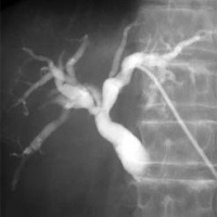 Colangiografia percutanea. 877603 Idime