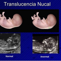 Ecografia obstetrica con translucencia nucal. 881436. Idime