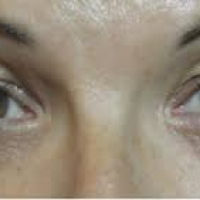 Electromiografia. Reflejo neurologico palpebral. Onda F y reflejo H. 891502  Idime