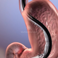 Retiro balon intragastrico. Uniendoscopia (2023)