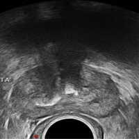 Ecografia de prostata transrectal  CON  biopsia Idime