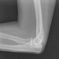 Radiografia de codo.873205  Idime