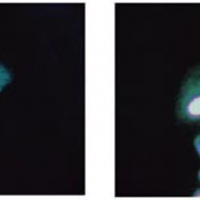 Gamagrafia de reflujo biliar. 920708 Idime (2024)