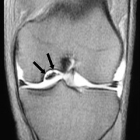Artrorresonancia de rodilla. 878812 Idime