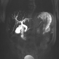 Colangiografia simple por resonancia nuclear magnetica.883434 Idime