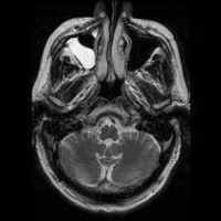 Resonancia magnetica de senos paranasales o cara. EN. Codigo CUPS 883110 (2022)