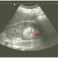 Ecografia renal, aorta, bazo. Ecografias Bogota (Mandalay)