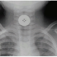 Extraccion cuerpo extraño tracto digestivo. Uniendoscopia (2023)