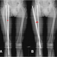 Radiografia de miembro inferior AP y lateral. 873340 Idime