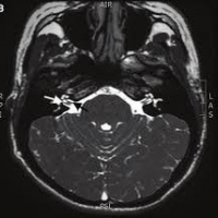 Resonancia nuclear magnetica de pares craneanos con contraste. 883108. Idime
