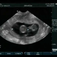 Ecografia obstetrica transvaginal. 881432 Idime