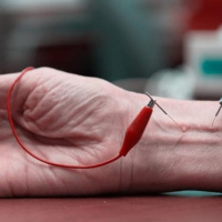 Sesion de electroacupuntura. Dra. Osorio