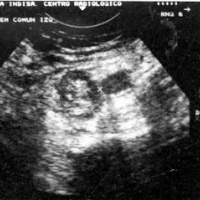 Ecografia doppler de flujo sanguineo en masas pelvicas.882294 Idime